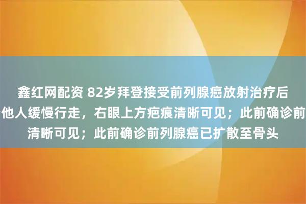 鑫红网配资 82岁拜登接受前列腺癌放射治疗后首次公开露面，扶着他人缓慢行走，右眼上方疤痕清晰可见；此前确诊前列腺癌已扩散至骨头